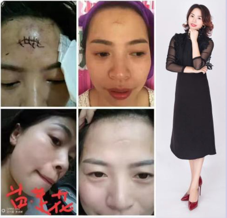 邓文清皮肤修复案例
