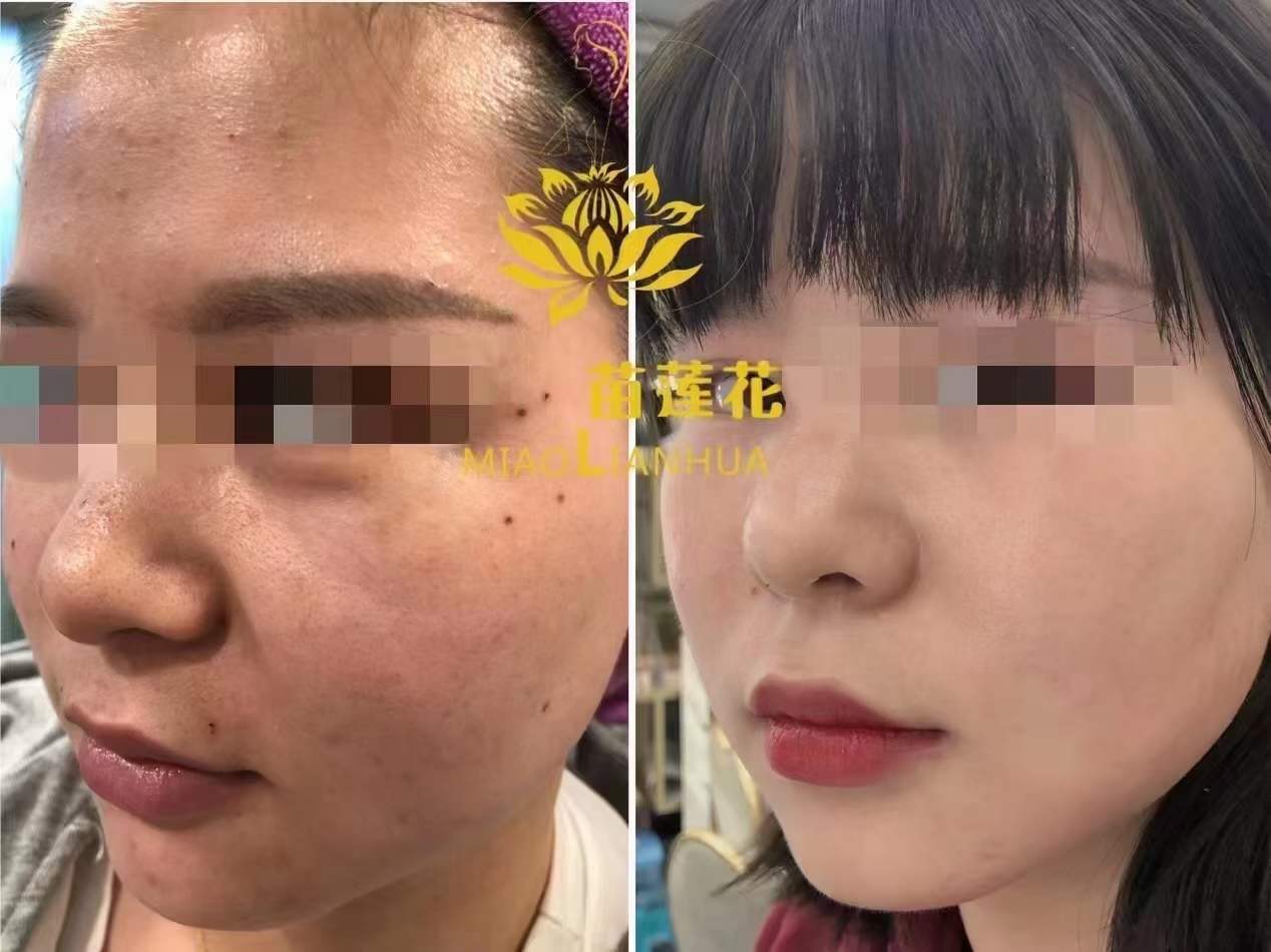 苗莲花祛斑效果对比图