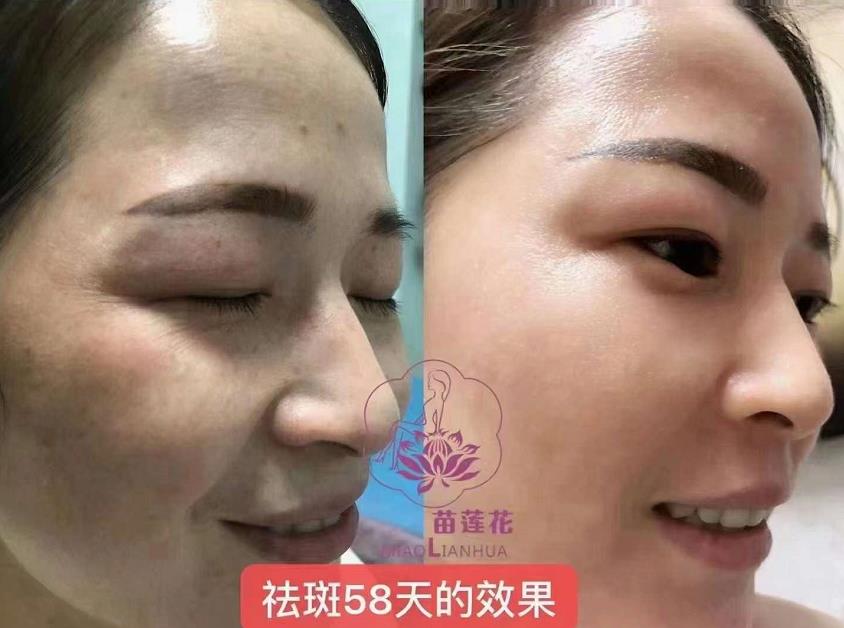苗莲花祛斑效果图