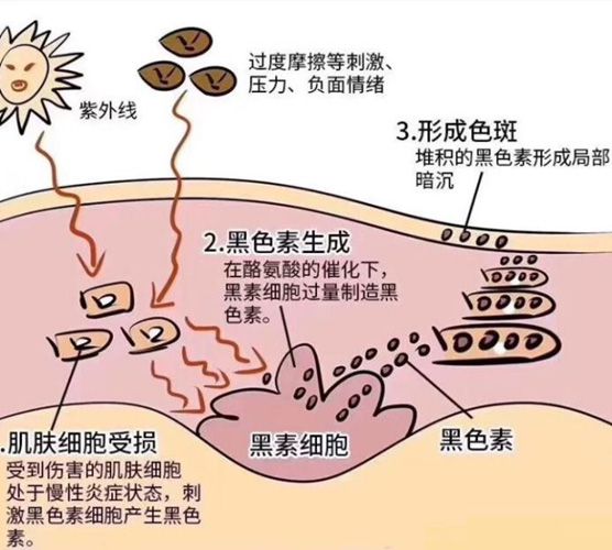为什么年纪轻轻就长斑？这是你必须了解的色斑知识！