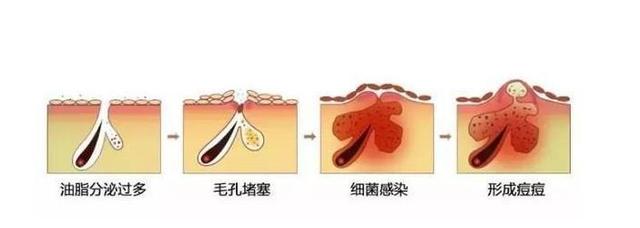 一波未平一波又起，反复长痘健康信号要警惕！