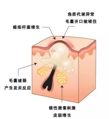 痘痘肌必看！痘肌护理的正确思路，赶紧收藏！