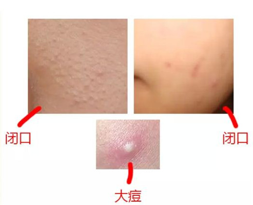 ↓↓↓夏天突然长闭口的姐妹进！